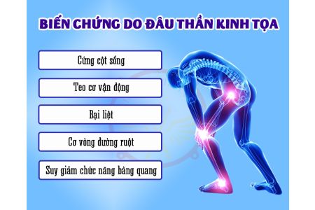 CÁCH GIẢM NGAY CƠN ĐAU THẦN KINH TỌA TẠI NHÀ HIỆU QUẢ BẤT NGỜ